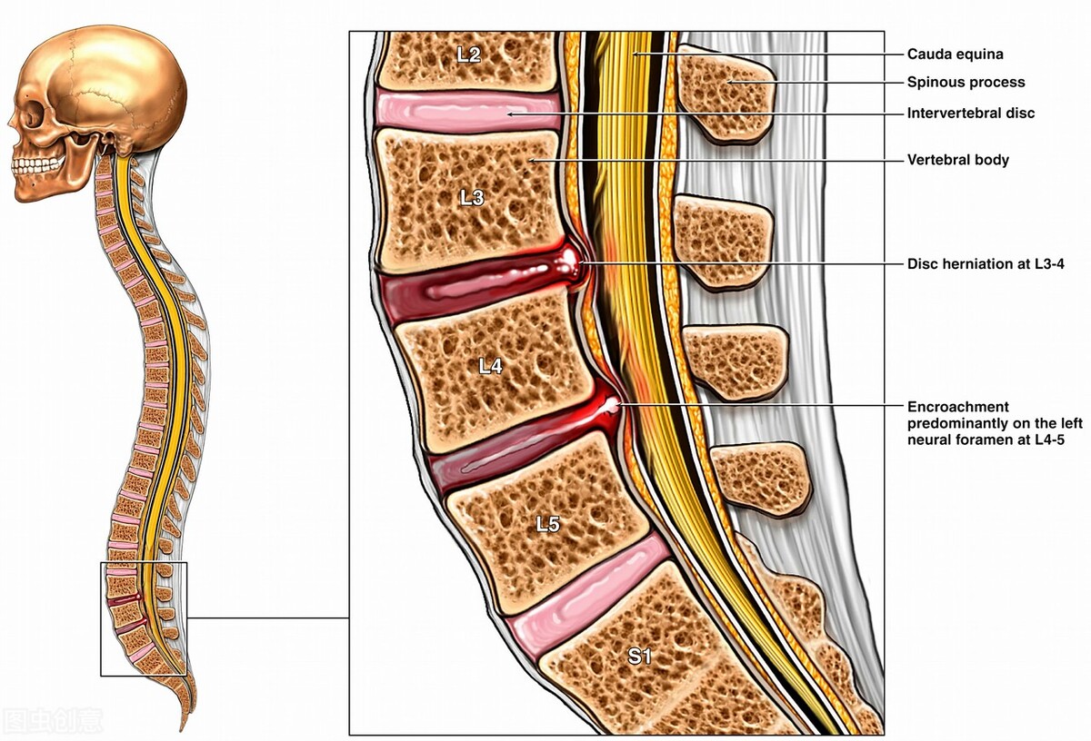 低颅压综合症,低颅压性头晕症状