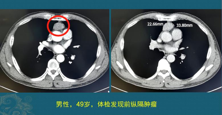健康体检就像下海打渔,癌细胞有漏网之鱼,绝户网成本太高了