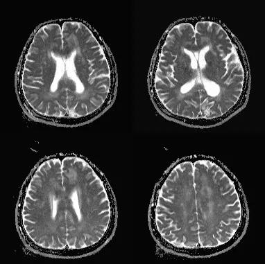 胼胝体有什么症状,胼胝体形态较小可以治疗吗