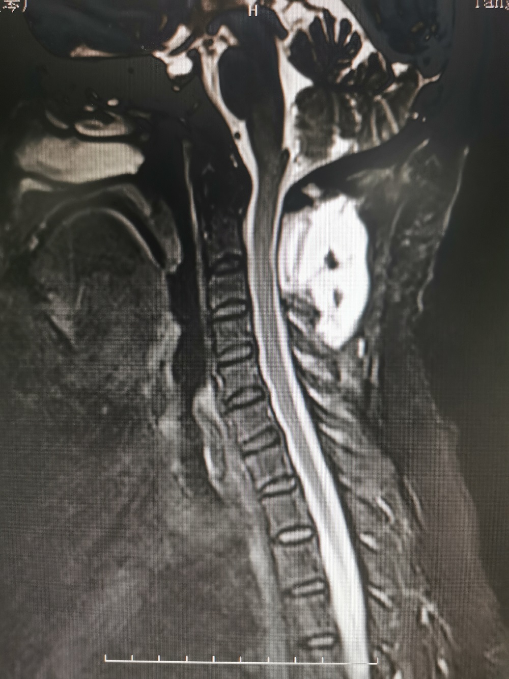 间歇性双手麻木是什么原因和征兆,双手指持续性发麻是什么原因