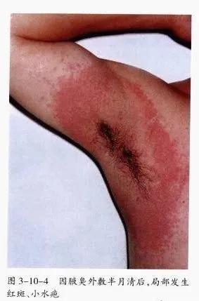 得接触性皮炎的原因有哪些,眼皮接触性皮炎用什么药膏