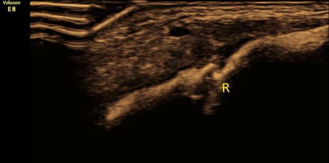 新生儿锁骨骨折原因有哪些,新生儿锁骨骨折是怎么回事
