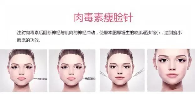 瘦脸针的效果怎么样呢,瘦脸针可以瘦双下巴吗