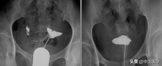 造影检查有必要做吗,输卵管造影前做什么检查项目