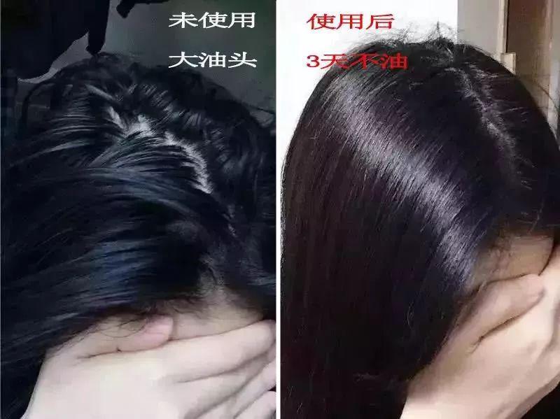 去头屑去螨虫哪个洗发水最有效,去头屑去螨虫用哪个洗发水最有效