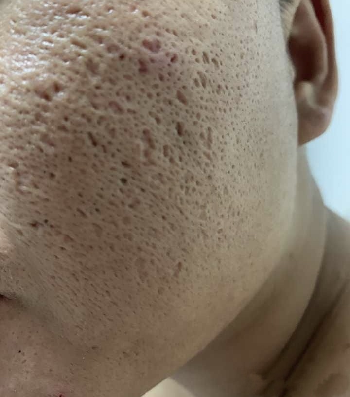 油皮毛孔粗大洗面奶,油皮毛孔粗大怎么补水