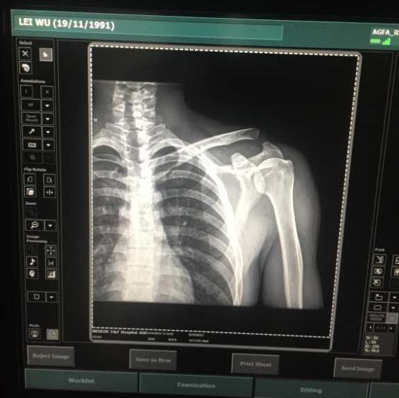 武磊亚洲杯伤情曝光,武磊伤情