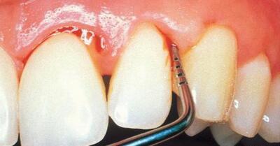 牙龈萎缩的原因及治疗方法,牙龈萎缩有什么办法解决