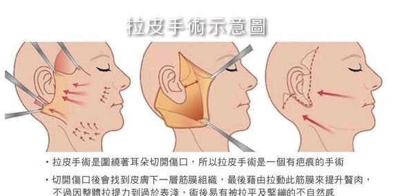 拉皮手术真人讲述案例,拉皮手术真实恢复期案例