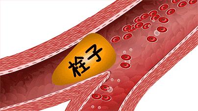 怎样预防脑梗死复发,如何预防脑梗死复发
