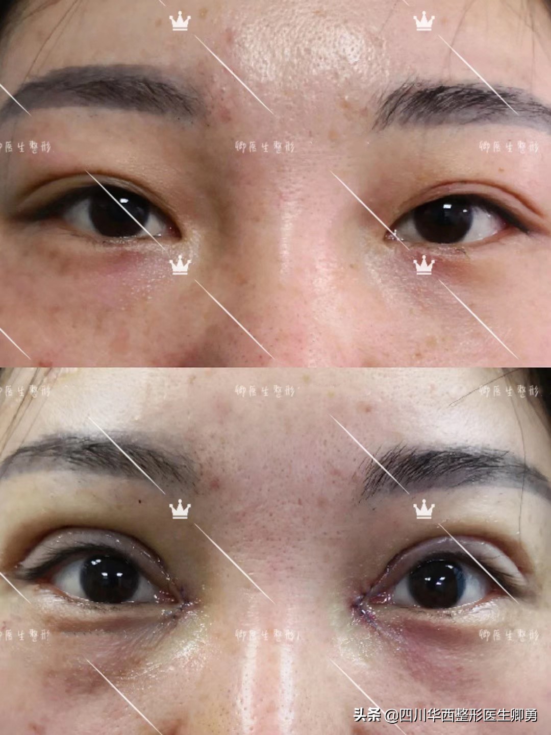 上海宇东修复双眼皮失败案例,双眼皮失败修复费用由谁承担