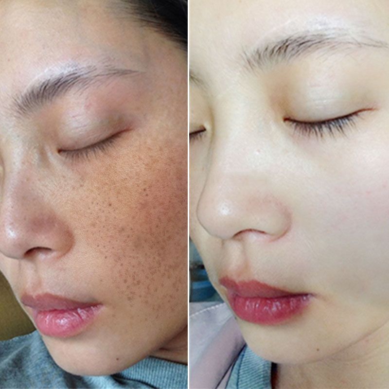 润泉贝儿祛斑产品怎么样,润泉贝儿美白祛斑套