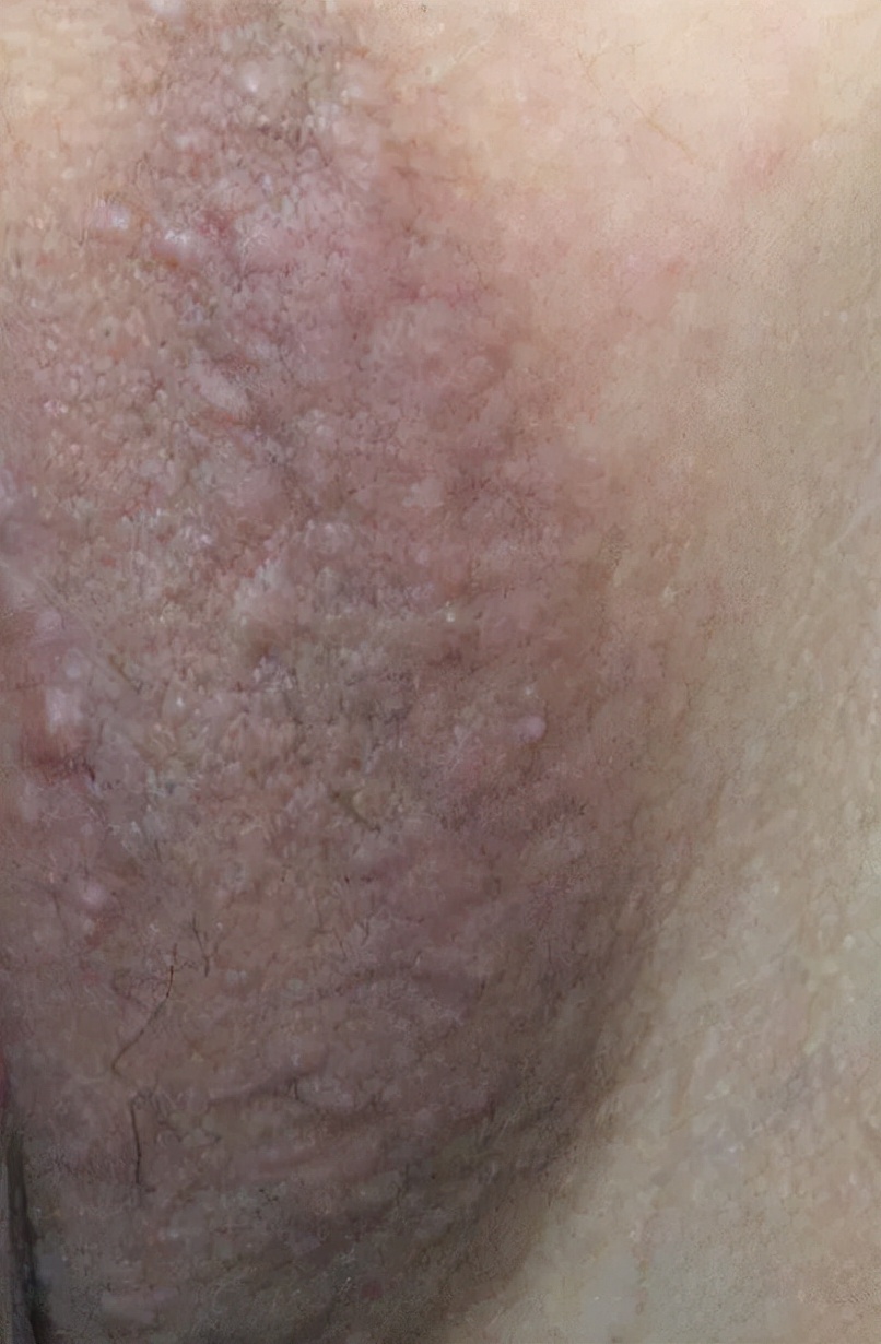 你以为的脂肪粒其实是肿瘤,脂肪粒会转变成癌吗