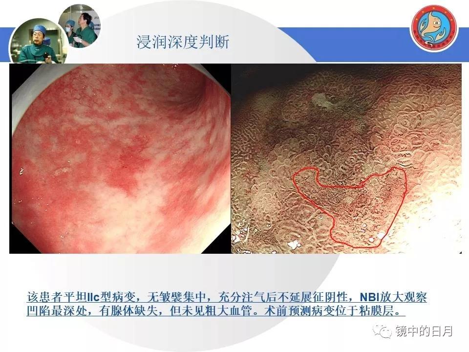 低分化胃癌早期时候做内镜手术吗,早期胃癌内镜手术后追加外科手术