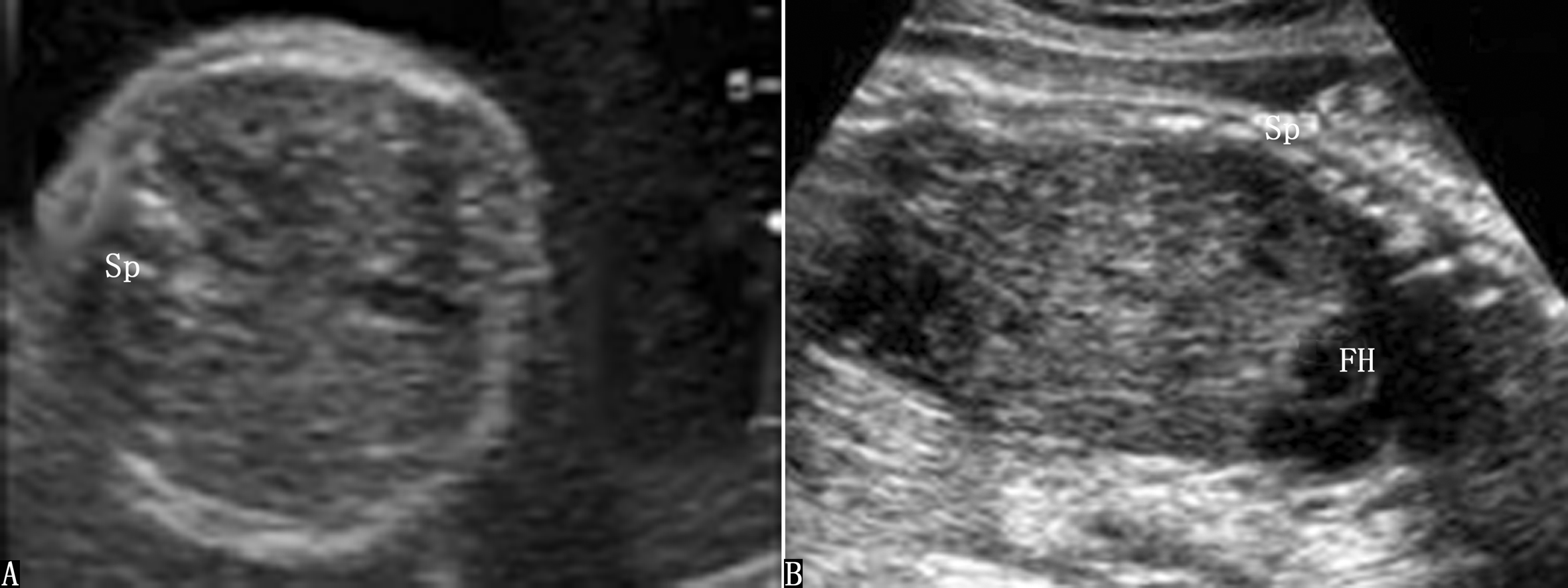 食道闭锁一般伴随什么畸形,胎儿消化道畸形超声能看出来吗