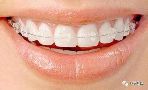 超详细的牙齿矫正过程,成人骨性牙齿矫正过程