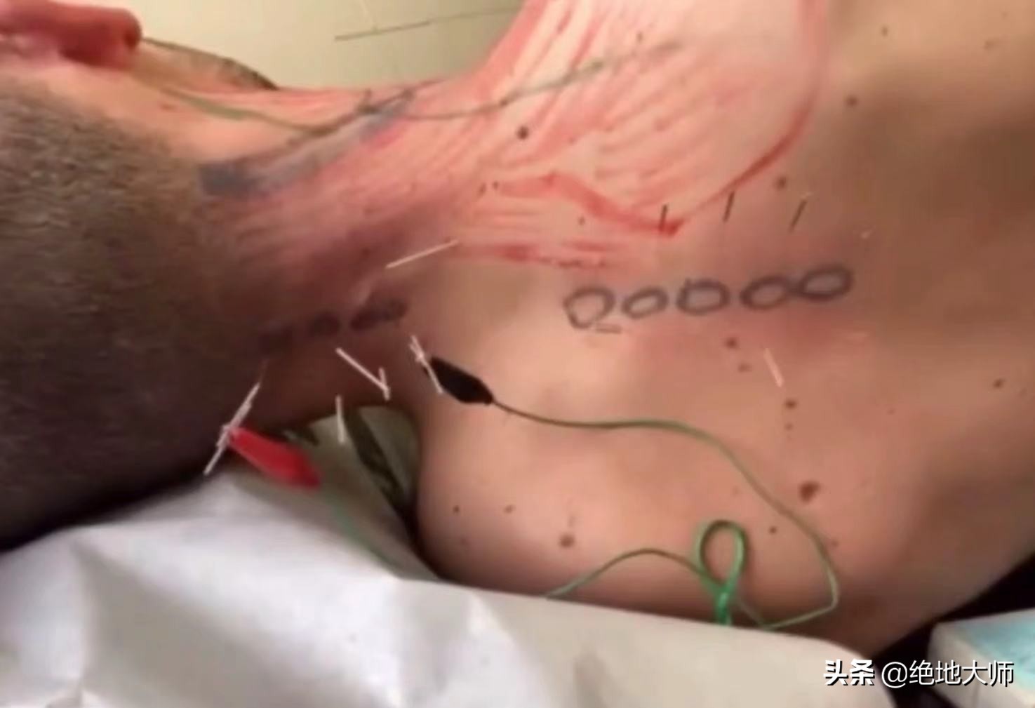 急性颈痛的神经调控康复治疗