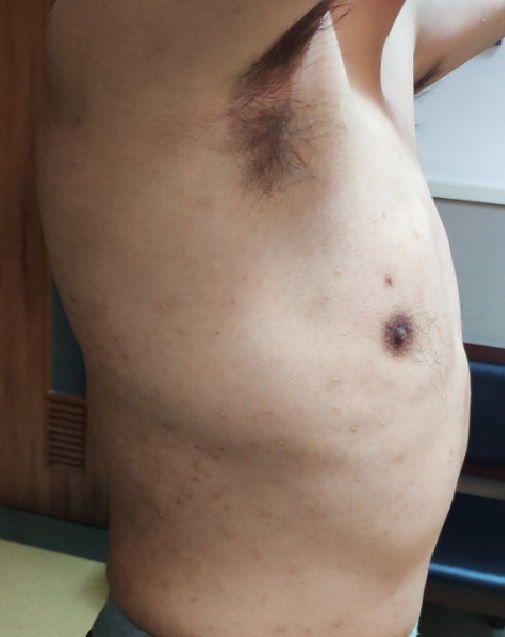 今天的Wenlin手术：桶状胸的微创矫治手术