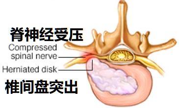 腰椎间盘突出可以进行腰椎复位吗,腰椎间盘突出腰部旋转