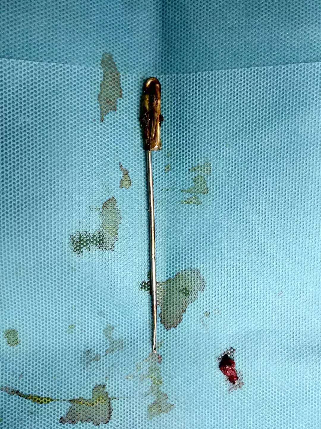 太冲动！男子与妻子拌嘴，一气之下吞16公分长针，穿透十二指肠