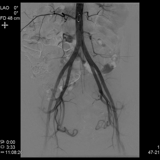 子宫腺肌病保守治疗无效怎么办?
