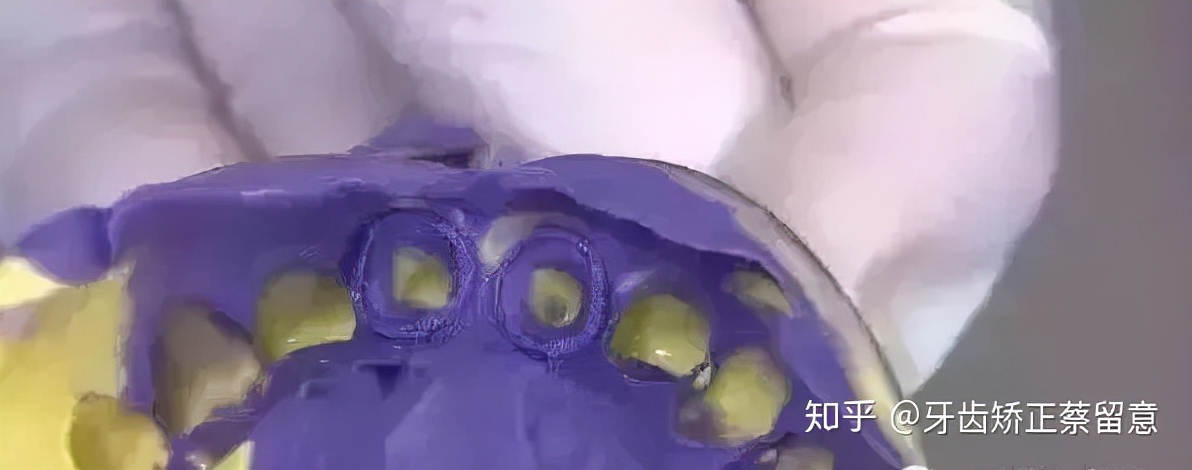 全瓷牙冠戴好了感觉咬合高了,戴了牙冠感觉大牙咬合不住