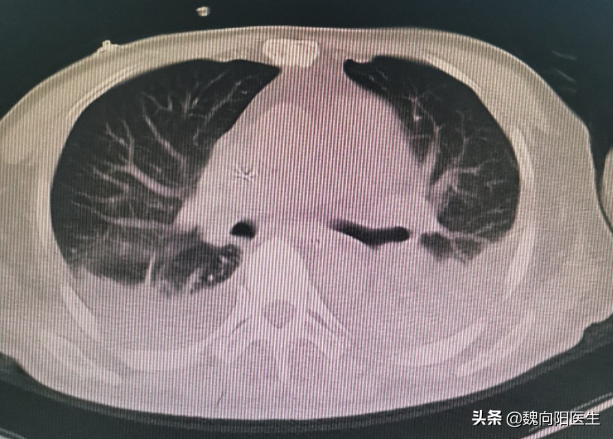 鍎跨鍖荤敓绉戞櫘鑲虹値濡備綍淇濆吇,瀹濆疂鑲虹値瀹堕暱濡備綍鎶ょ悊