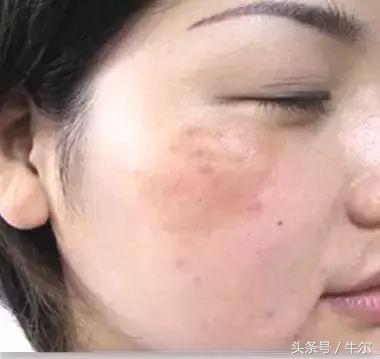 斑到底怎么样才真正去掉,斑怎么祛除最快最有效