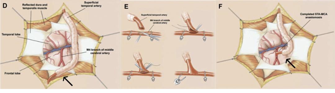 烟雾病的治疗后有疤痕吗,烟雾病的治疗