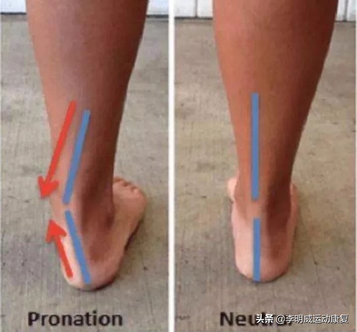 如何矫正足外翻四岁半,怎样矫正足外翻视频