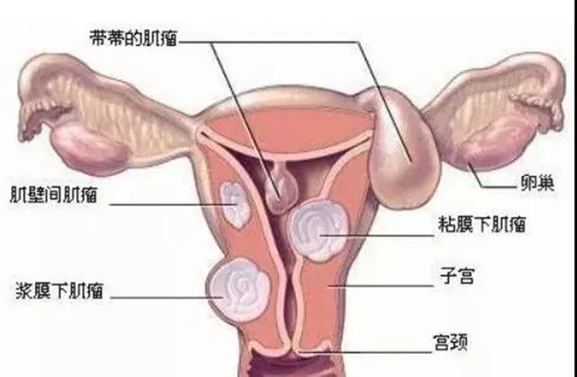 子宫肌瘤切了还长应该注意什么,子宫肌瘤会留下病根吗