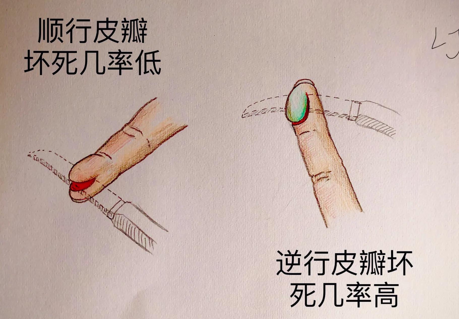 手被割伤如何处理,手被割伤了较深要如何处理