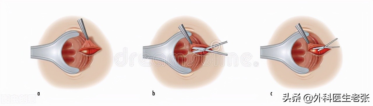 三岁孩子肛裂是怎么治疗,三岁小孩肛裂怎么治