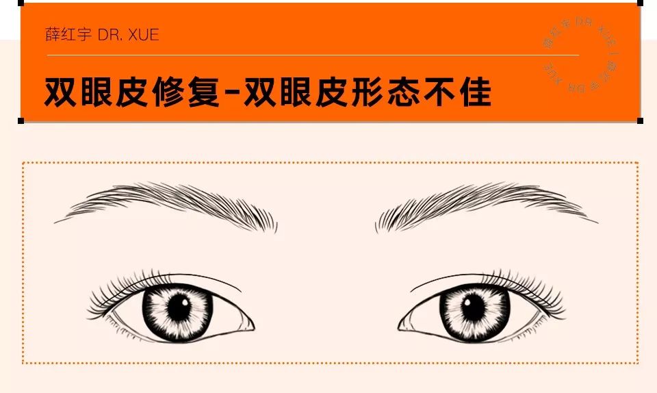 双眼皮整形修复,潘贰双眼皮修复