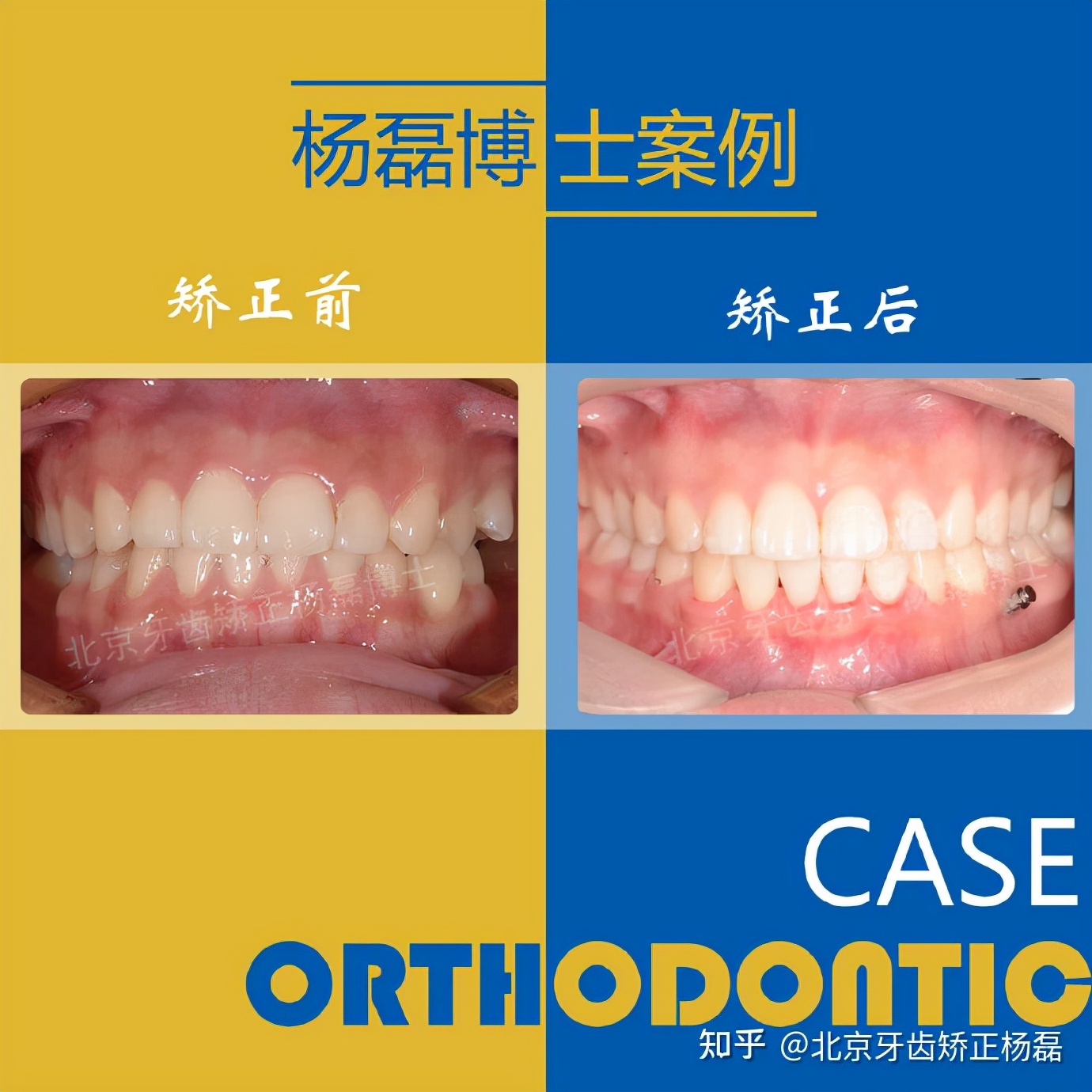 整牙半隐形牙套,缺牙可以用隐形牙套矫正的全过程