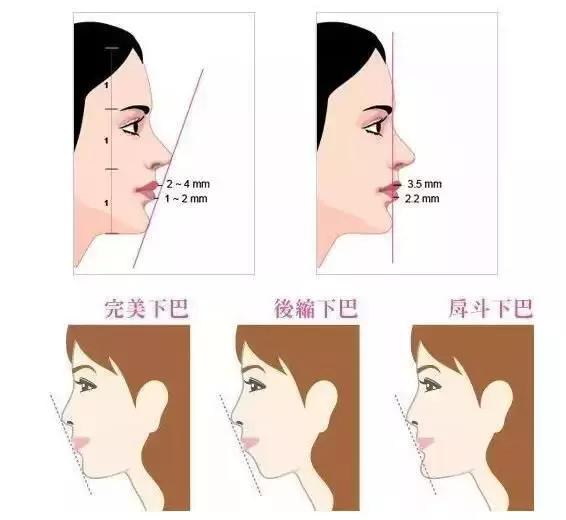 丰下巴可以改善下巴后缩么,丰下巴手术前后对比照片