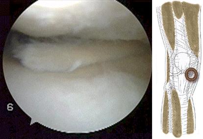 半月板撕裂手术后怎么自己做康复,半月板撕裂手术最佳自愈方法