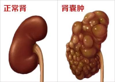 掌健识健康百科,肾脏引起的手指肿胀应该怎么办