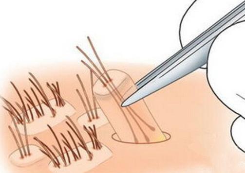 南昌市第12医院植发科,南昌第12医院植发效果怎么样