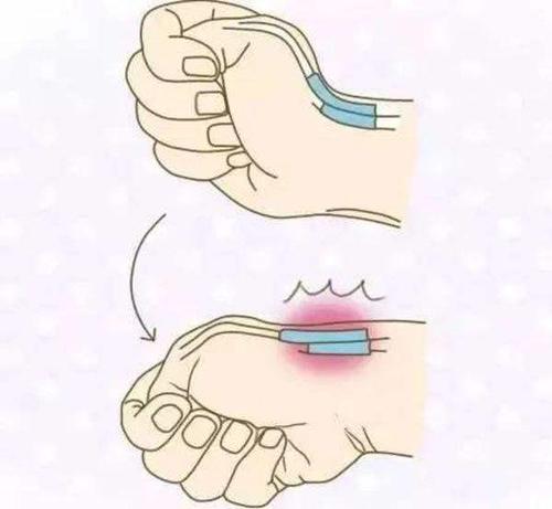 腱鞘炎不治会引起严重后果吗,腱鞘炎长期不治疗有什么危害