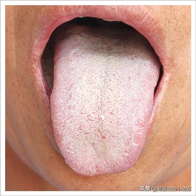 中医舌诊对照表100例,舌诊辨九大体质