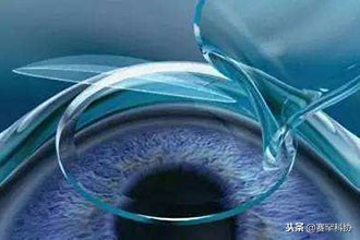 激光近视手术激光能量多大,激光近视手术和飞秒激光的区别