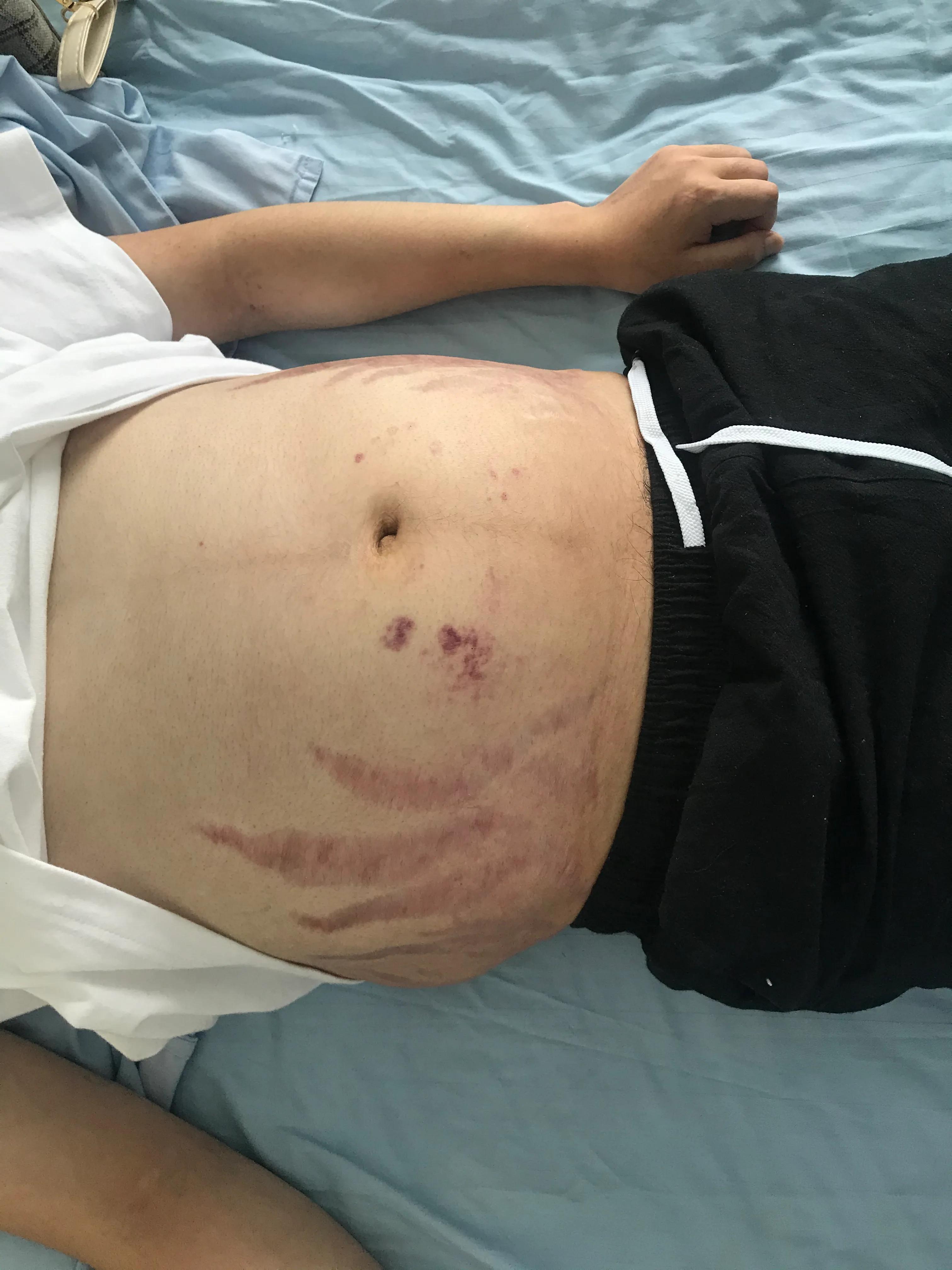 男人肾积水引起的原因,男性肾积水是什么原因引起的