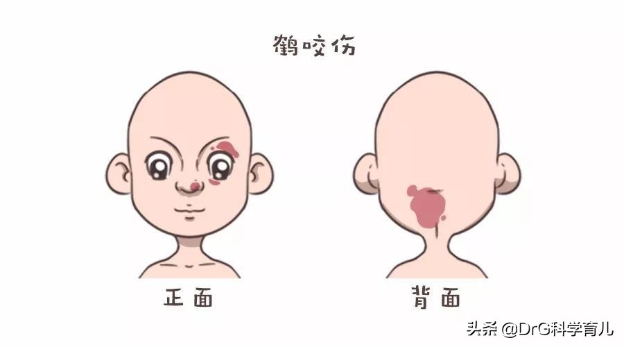 天生胎记黑毛痣会癌变会死吗,脖子上有个黑色胎记会癌变吗