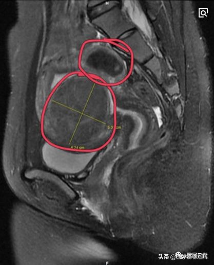 18种泌尿生殖系统常见疾病MR诊断总结