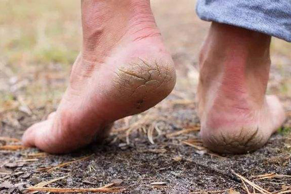 修脚神器去死皮磨脚刮脚后跟老茧,脚后跟死皮又厚又硬教你一招