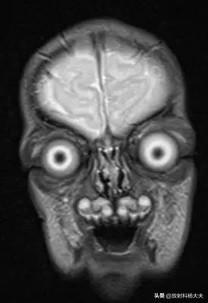 脑出血几年以后复发,脑出血几年后偏瘫越来越严重