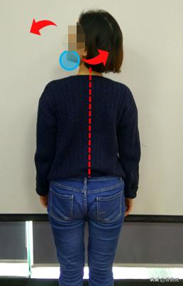 怎么预防脖子有个富贵包,脖子后的富贵包真是夺命包