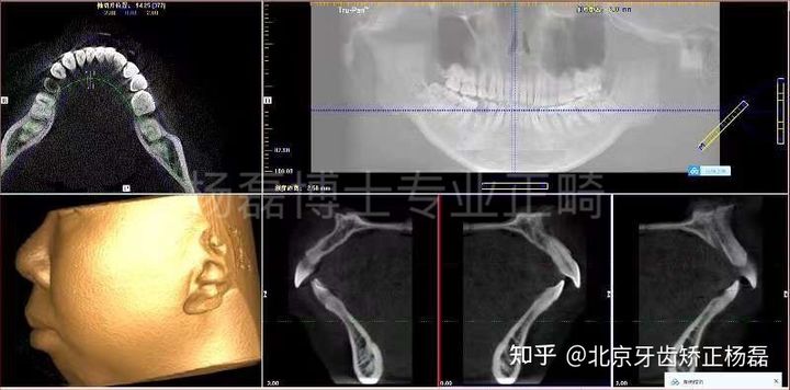 颞下颌关节紊乱精神紧张复发,颞下颌关节紊乱症能做牙齿矫正吗