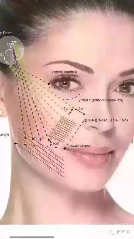 什么是线雕图片,什么是线雕线雕效果怎么样